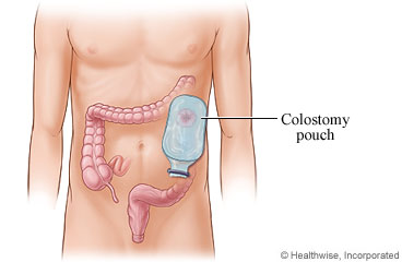 Colostomy in dubai